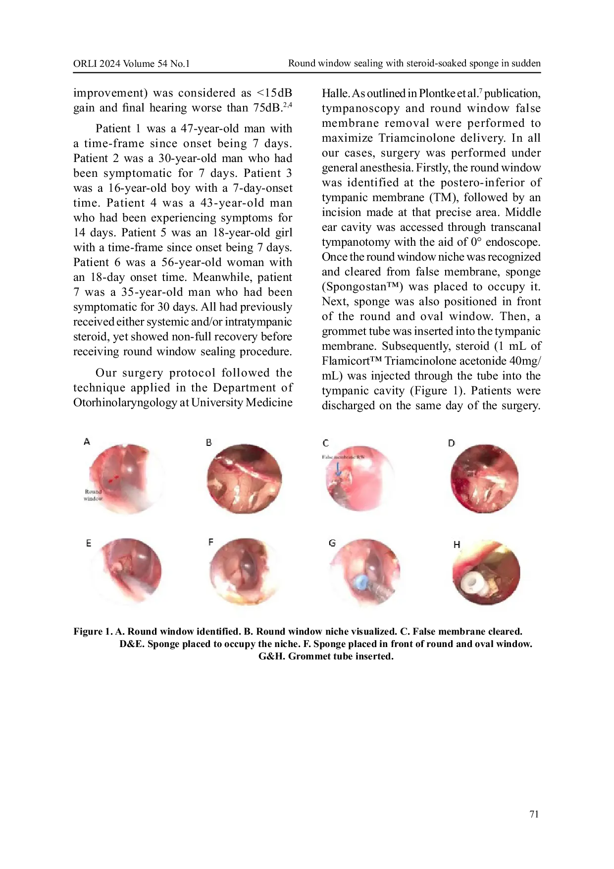 JURIS Round window sealing with steroid soaked sponge in sudden sensorineural hearing loss