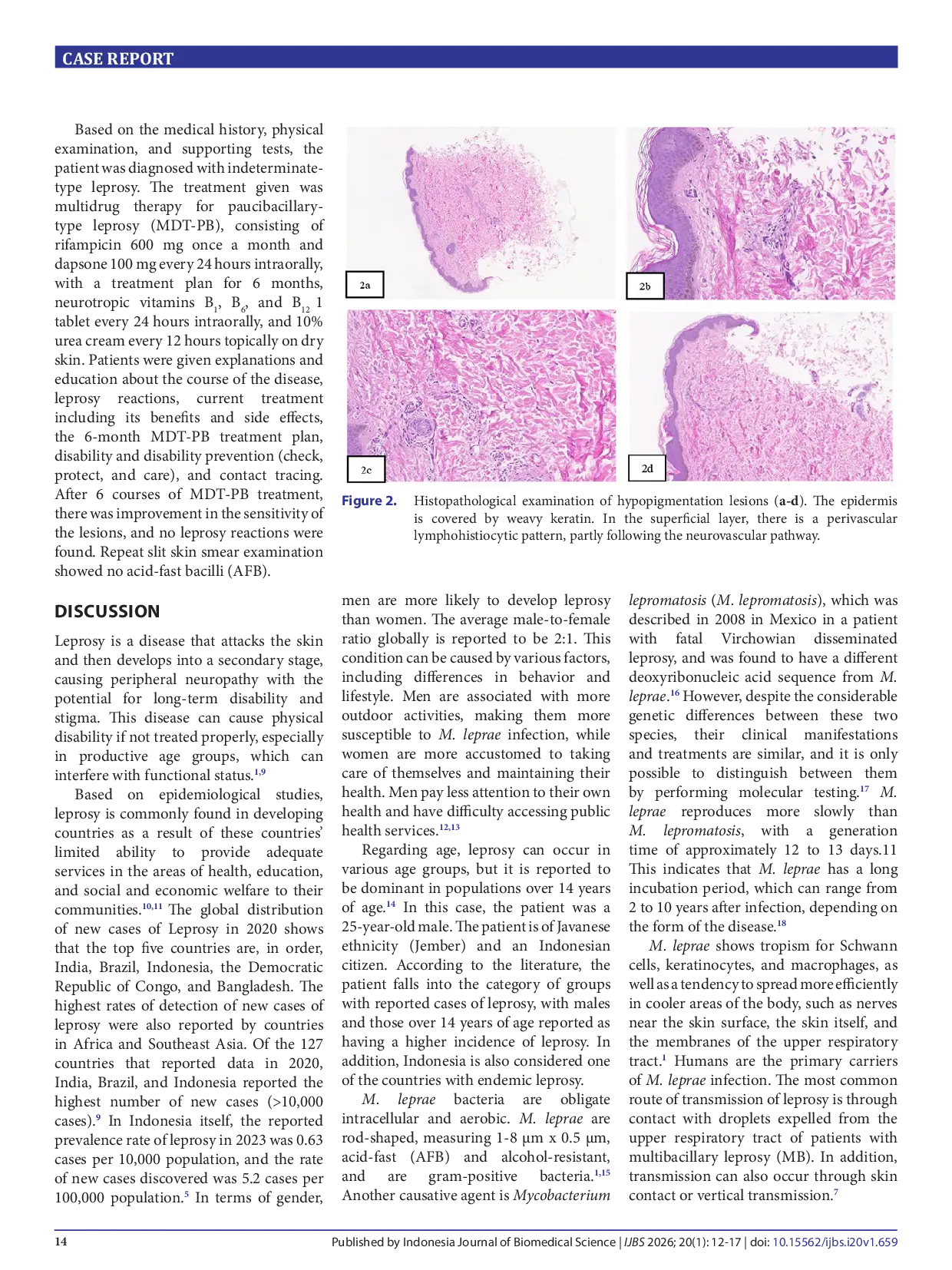 JURIS Indeterminate Leprosy Case Report and Literature Review