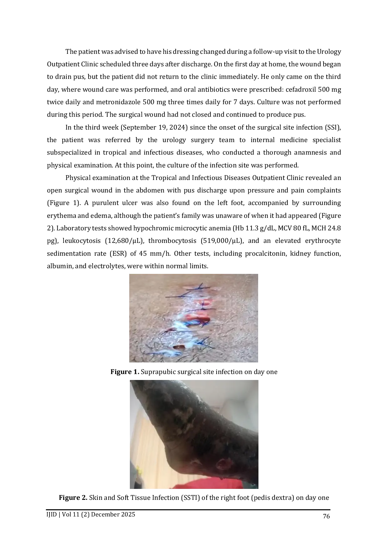 JURIS Infeksi Luka Operasi Yang Diabaikan Karena Acinetobacter Baumannii Dan Klebsiella Pneumoniae Multiresisten