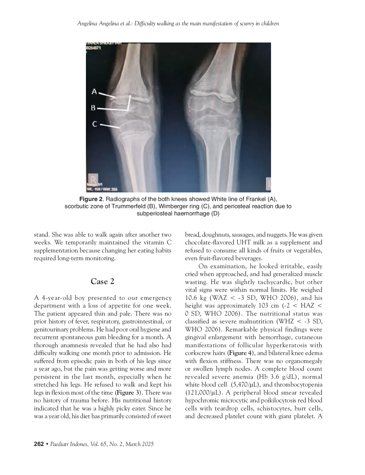 JURIS Difficulty walking as the main manifestation of scurvy in children two cases from a resource limited setting