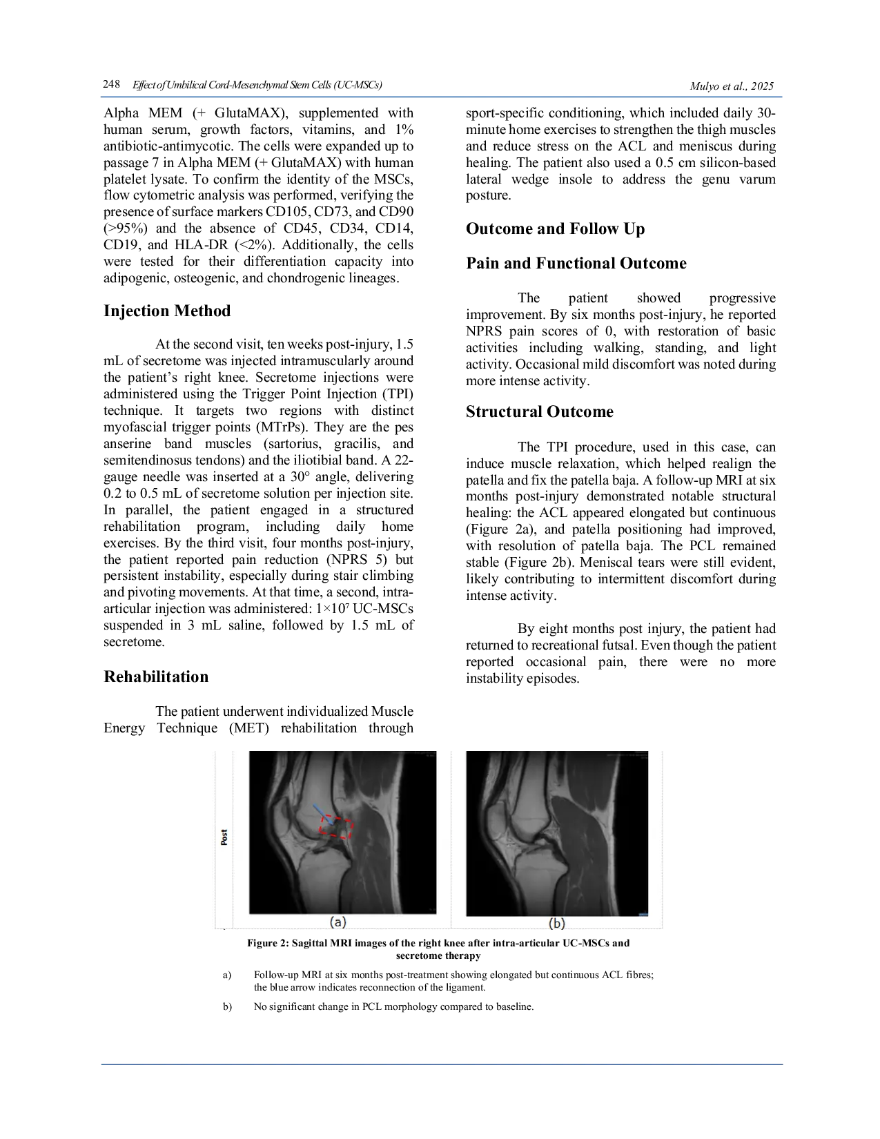 JURIS Effect of Umbilical Cord Mesenchymal Stem Cells UC MSCs Derived Secretome Combined with UC MSCs in Anterior Cruciate Ligament Tear A Case Report