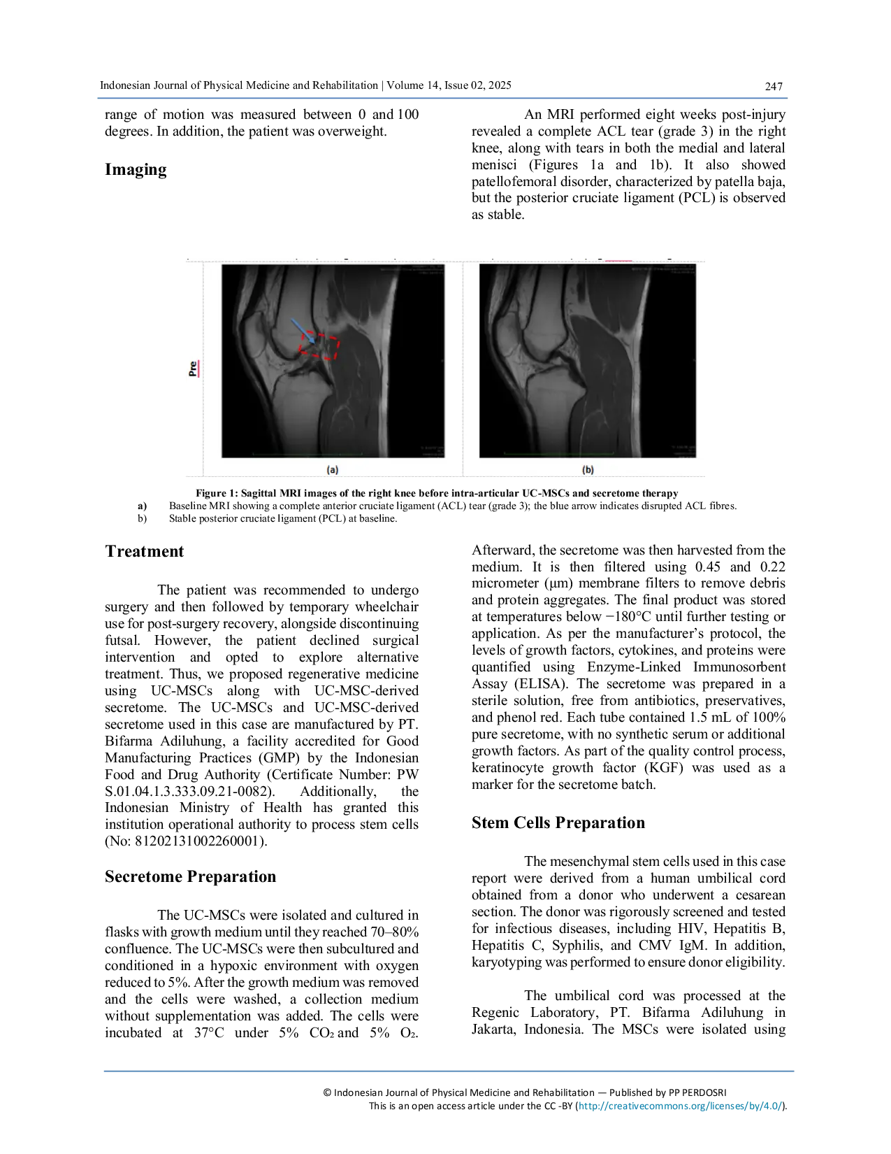 JURIS Effect of Umbilical Cord Mesenchymal Stem Cells UC MSCs Derived Secretome Combined with UC MSCs in Anterior Cruciate Ligament Tear A Case Report