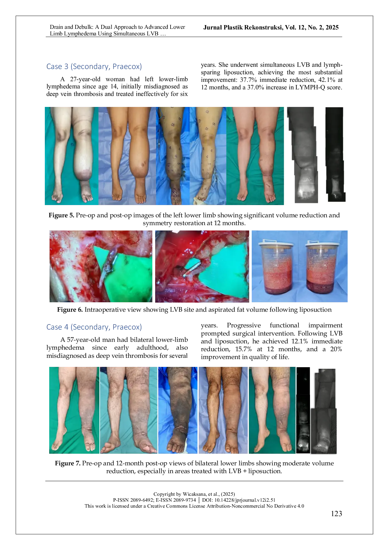 JURIS Drain and Debulk A Dual Approach to Advanced Lower Limb Lymphedema Using Simultaneous LVB and Lymph Sparing Liposuction