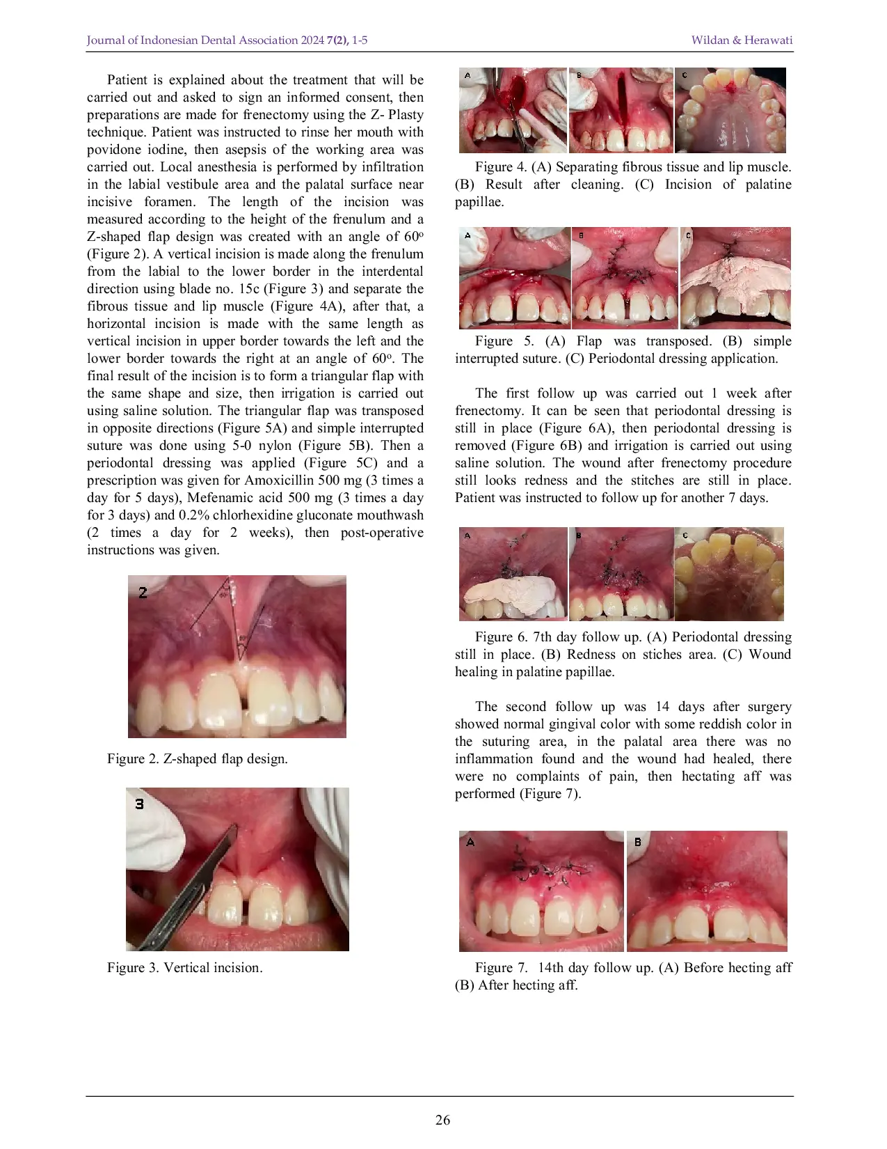JURIS Frenectomy Using Z Plasty Technique in Case of Aberrant Frenum on Aesthetic Zone