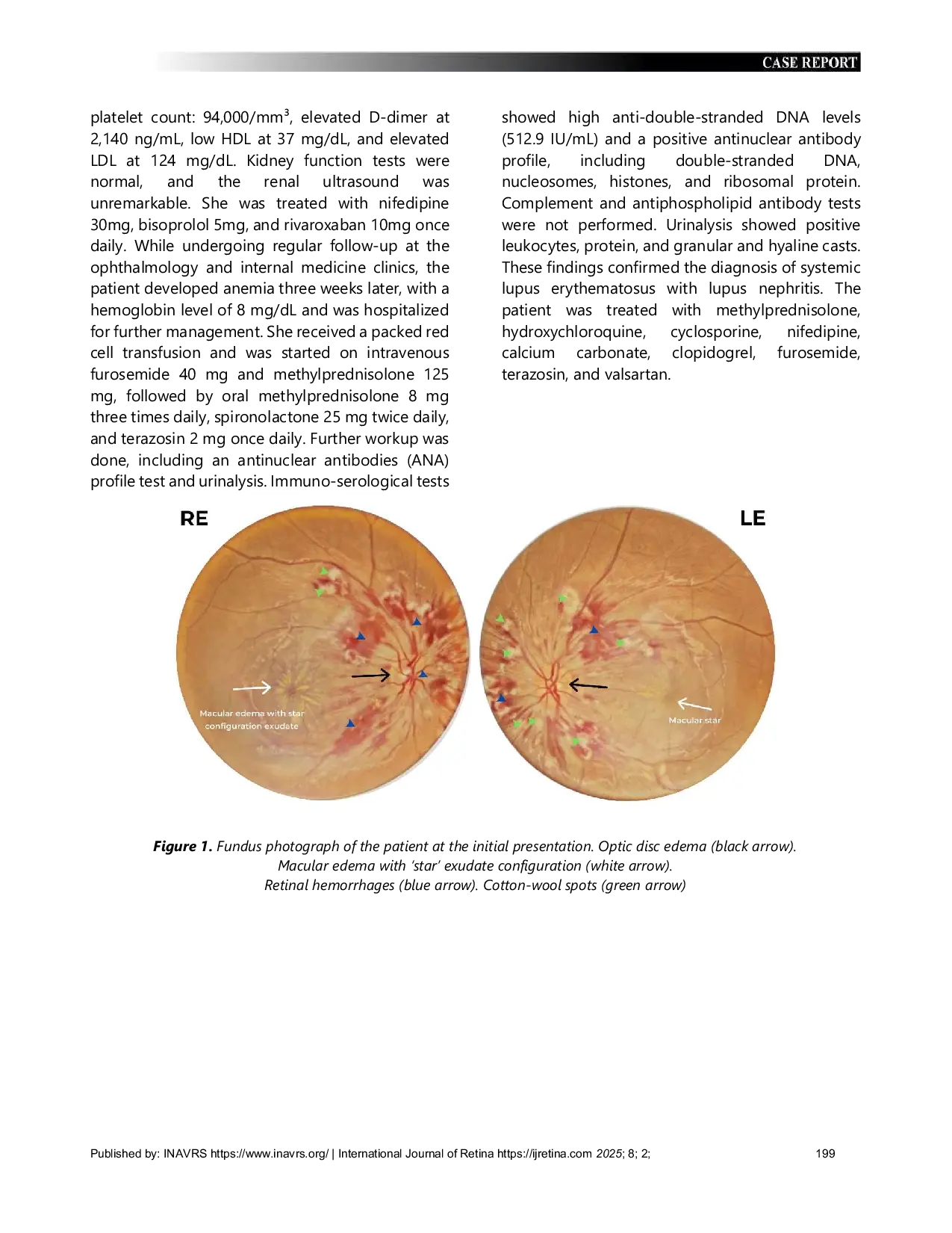 JURIS Hypertensive Optic Neuropathy As A Presentation Of Systemic Lupus Erythematosus A Case Report