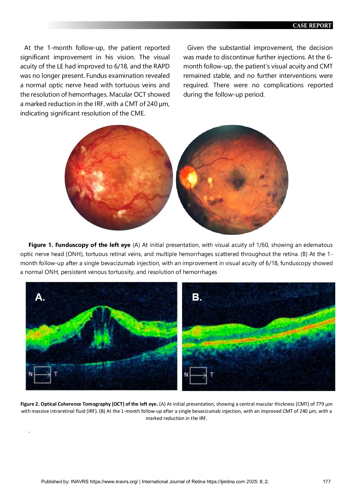 JURIS Restoring Vision in Central Macular Edema CME Caused by Central Retinal Vein Occlusion CRVO Single Intravitreal Bevacizumab Injection