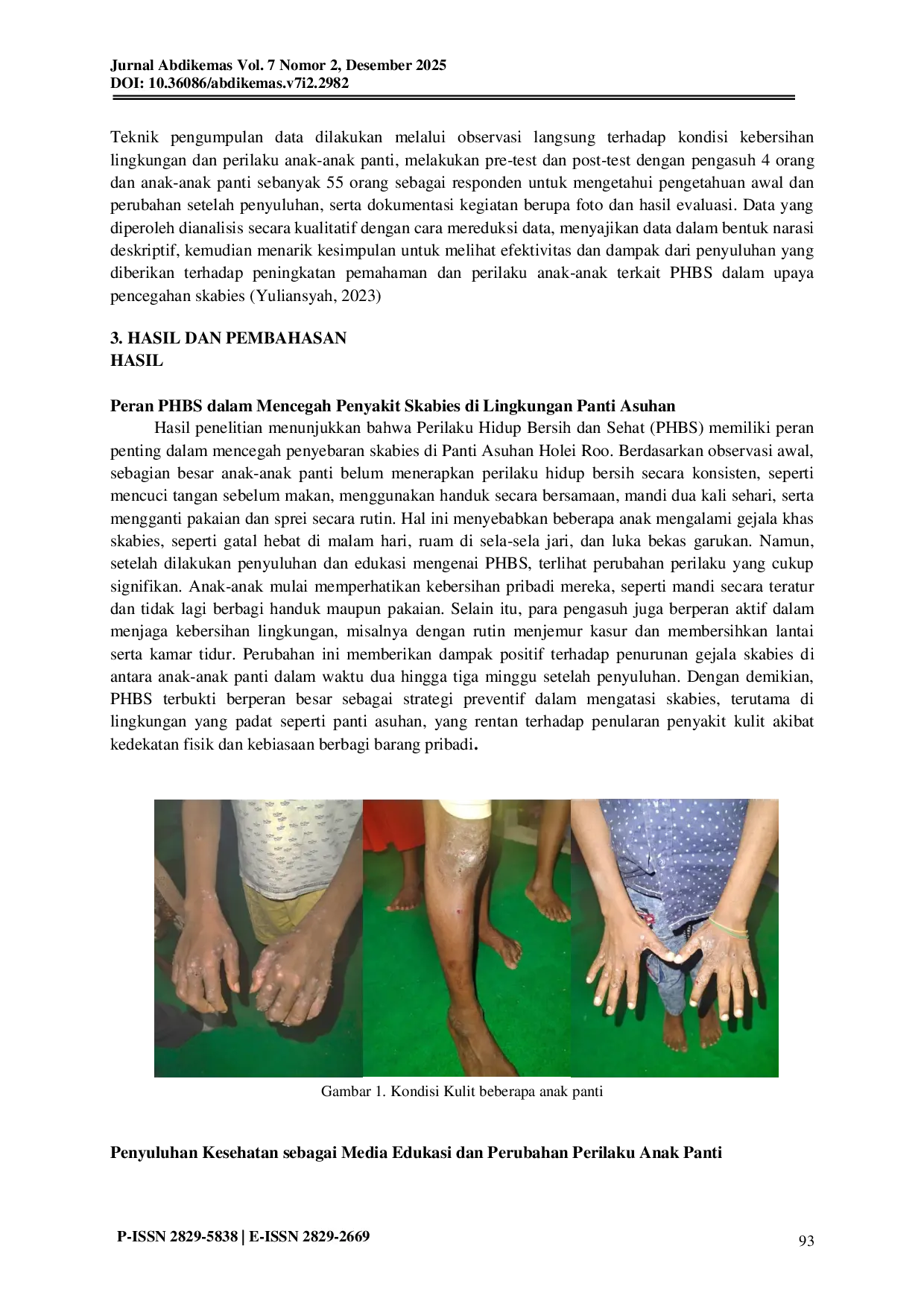 JURIS Penyuluhan PHBS Dalam Pencegahan Skabies Di Panti Asuhan Holei Roo Kabupaten Jayapura Papua