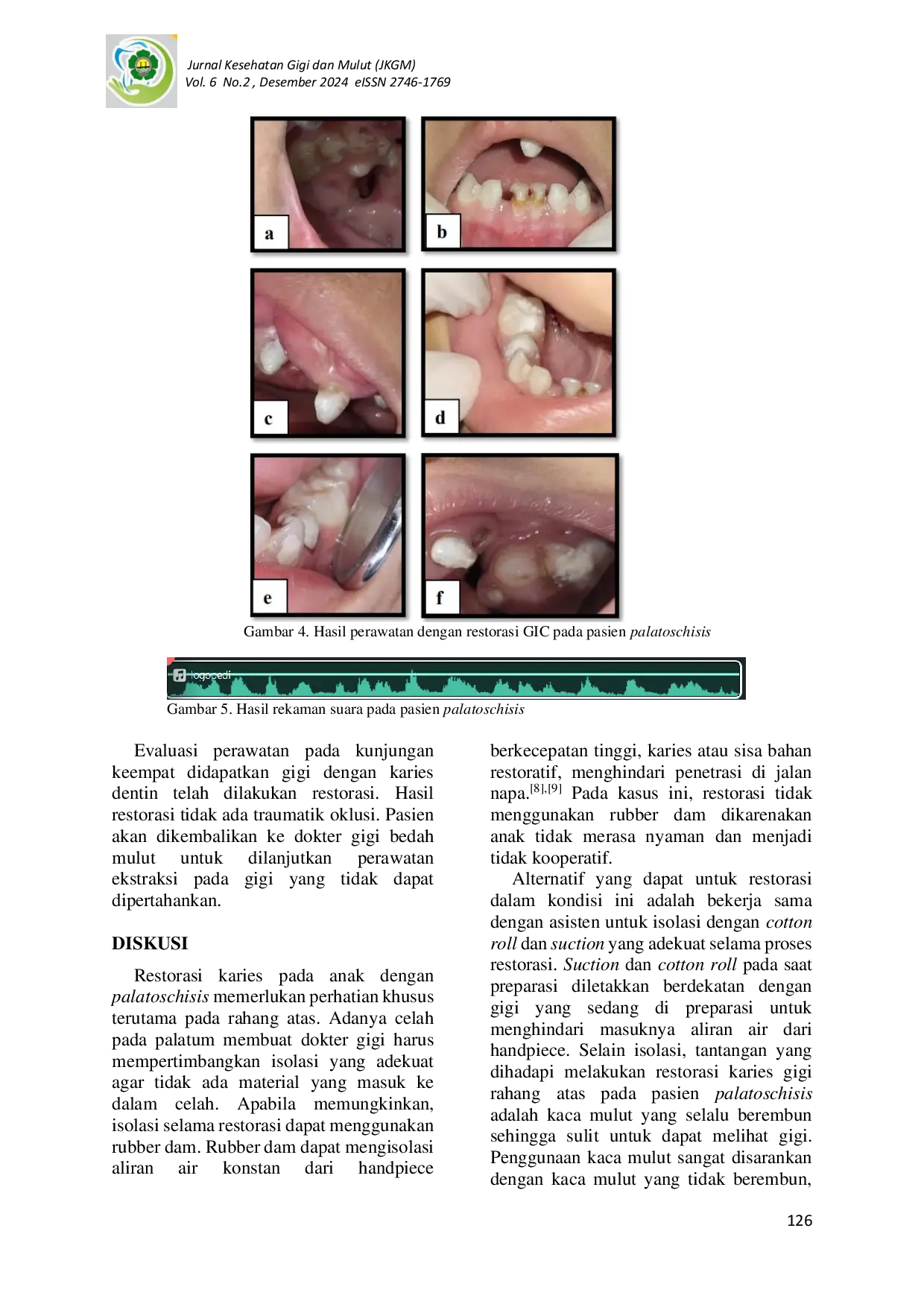 JURIS Restorasi Karies Gigi Pada Anak Usia 6 Tahun 6 Bulan Sebagai Persiapan Palatoplasty Laporan Kasus
