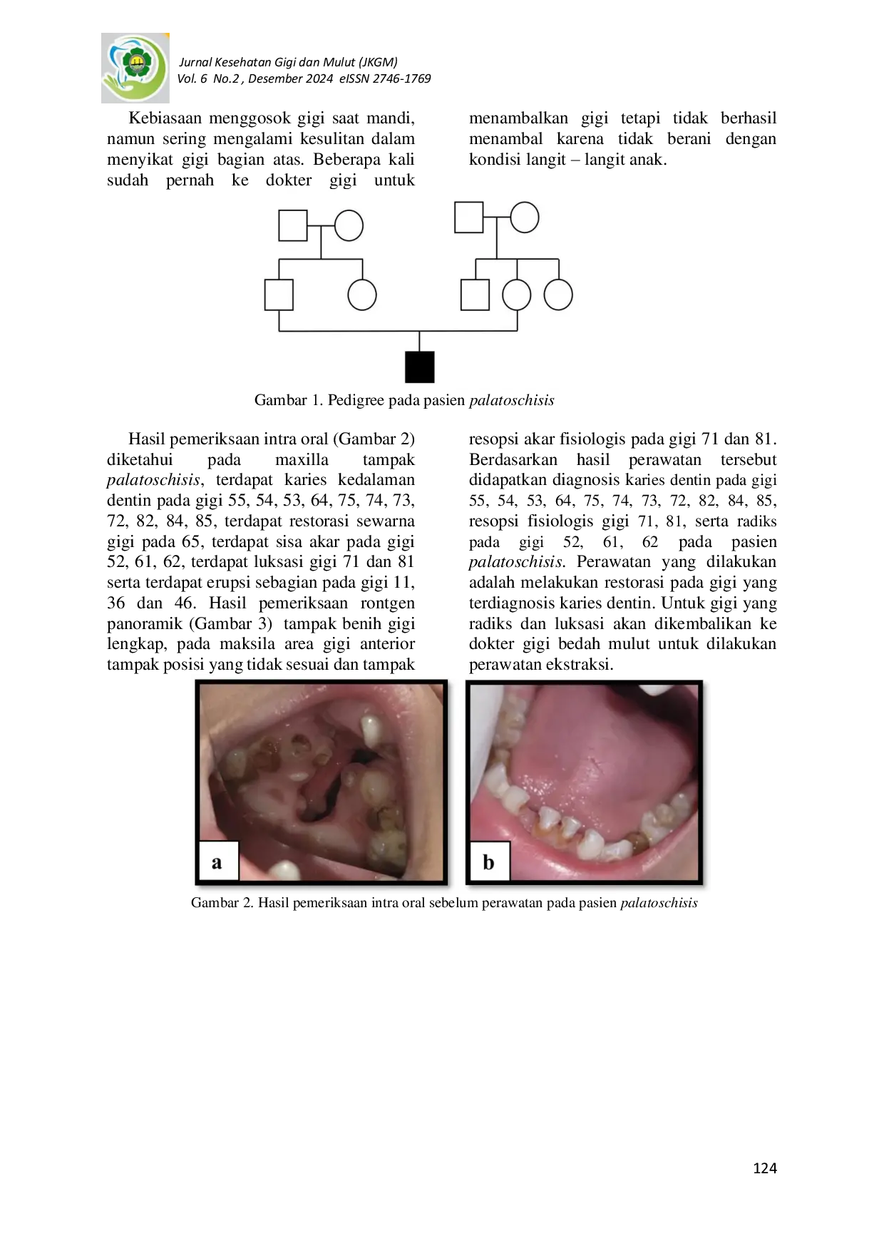 JURIS Restorasi Karies Gigi Pada Anak Usia 6 Tahun 6 Bulan Sebagai Persiapan Palatoplasty Laporan Kasus