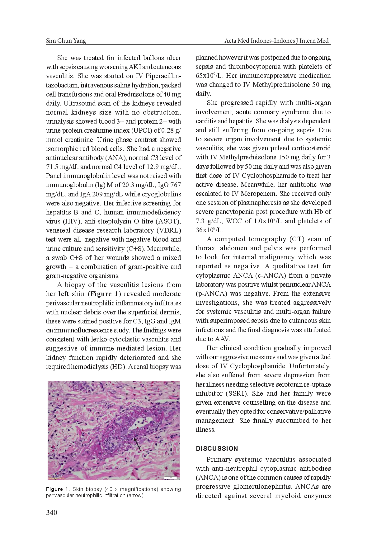 juris Fleshy Skin Cellulitis A Triggering Factor for ANCA Associated Vasculitis