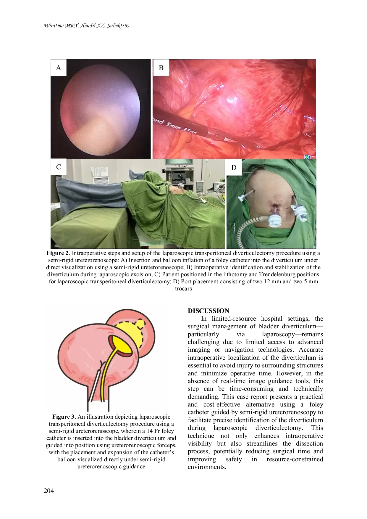 JURIS Foley Catheter Guided by Semi Rigid Ureterorenoscopy in the Treatment of Bladder Diverticulum A Case Report