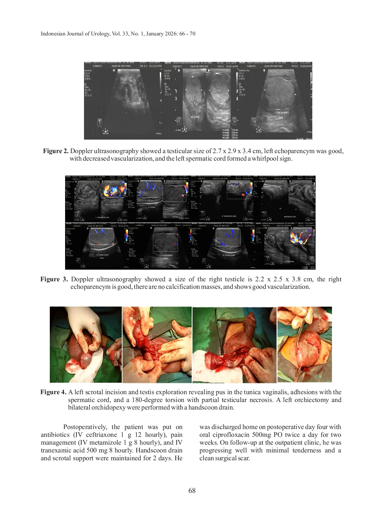 JURIS Testicular Torsion Induced by Epididymo Orchitis A Rare Case Report Study