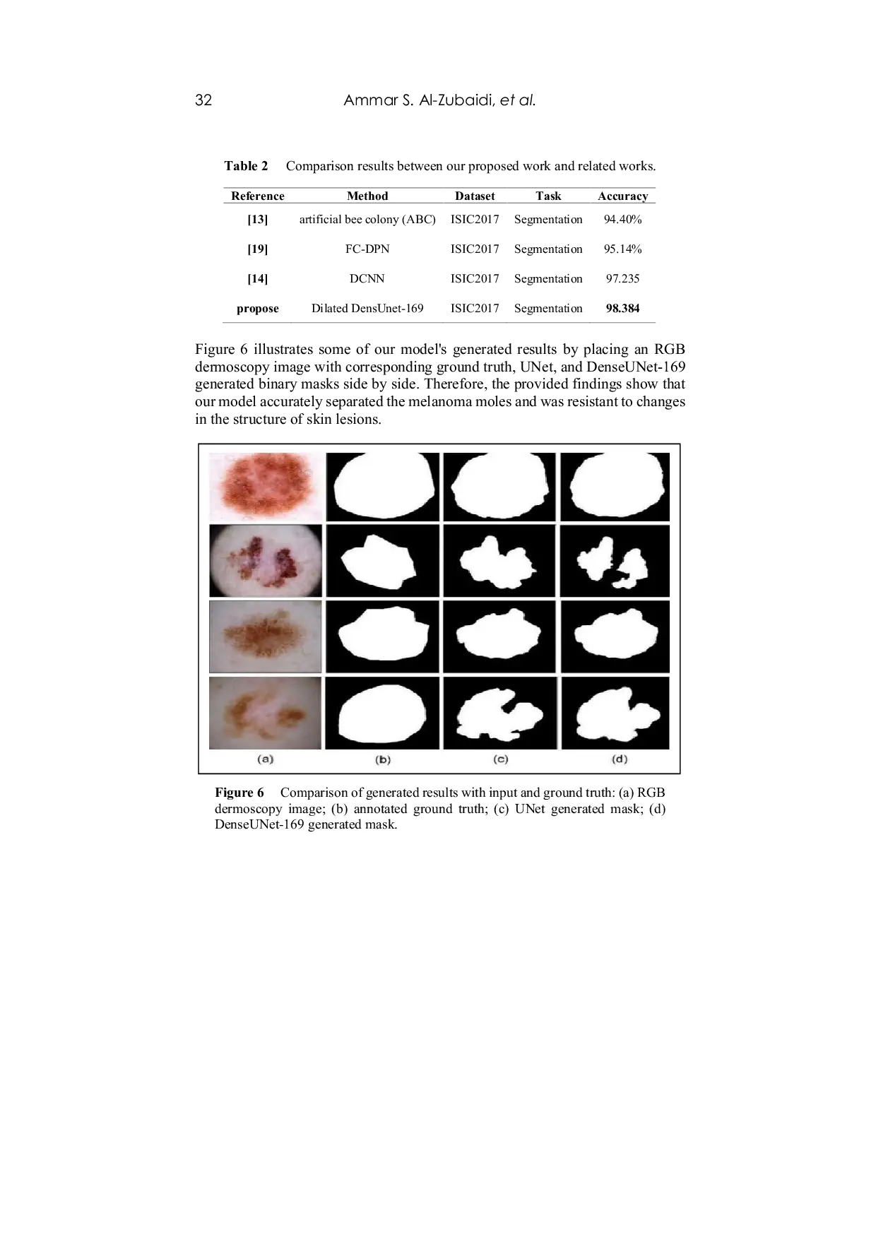 JURIS Skin Lesion Segmentation for Melanoma Using Dilated DenseUNet