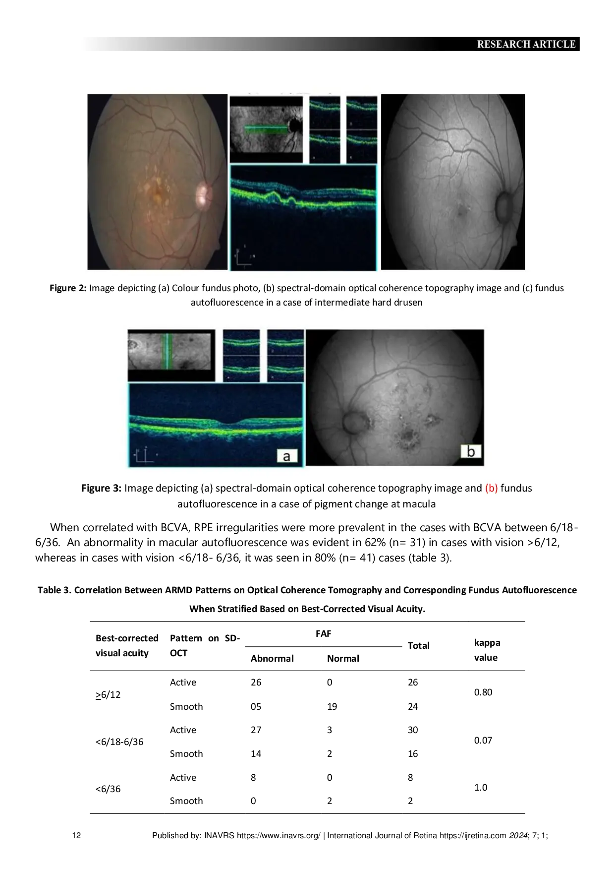 JURIS Assessment of early and late dry age related macular degeneration with spectral domain optical coherence tomography and fundus autofluorescence
