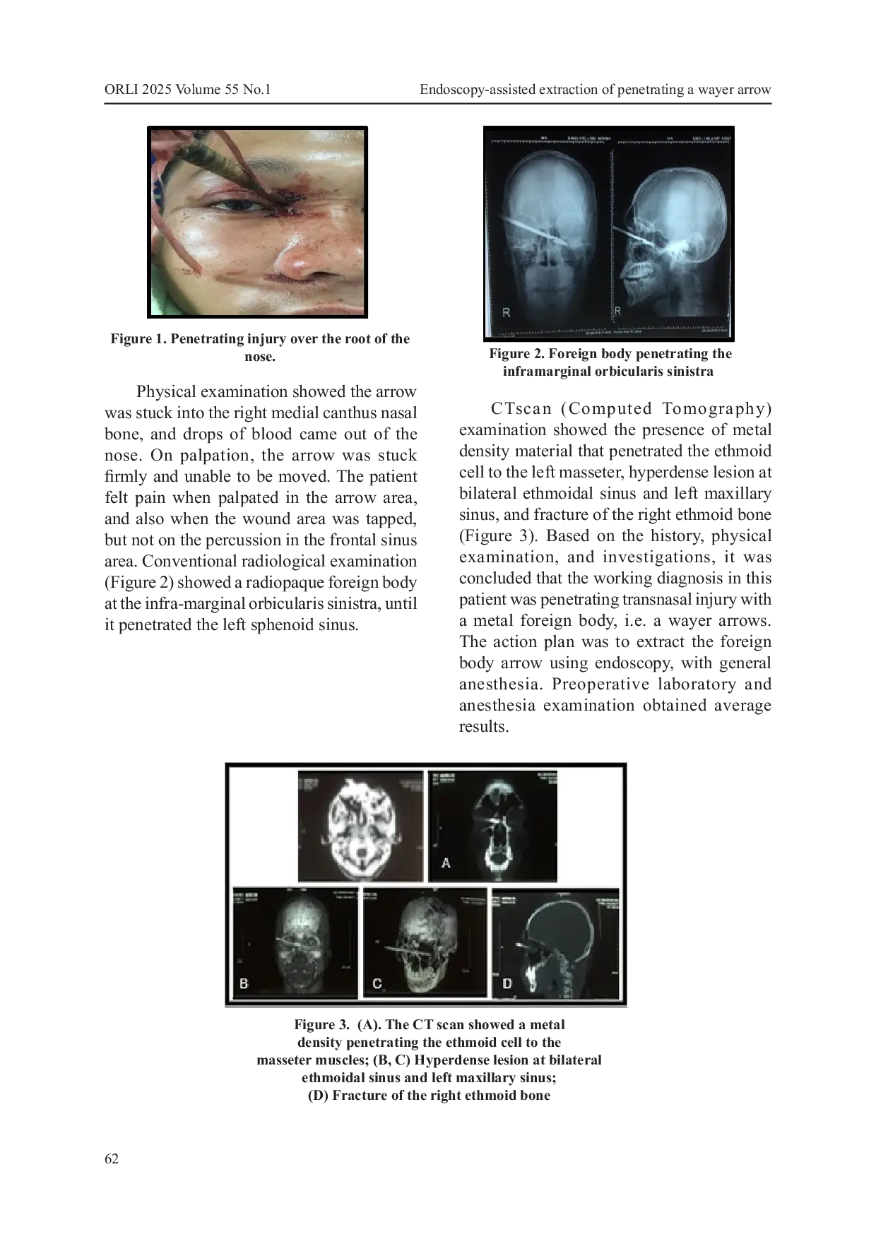 JURIS Endoscopy Assisted Extraction of Penetrating a Wayer Arrow in the Ethmoid Sinus