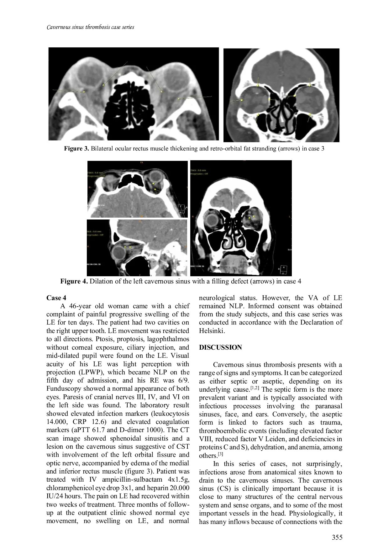 JURIS Cavernous sinus thrombosis a case series analysis