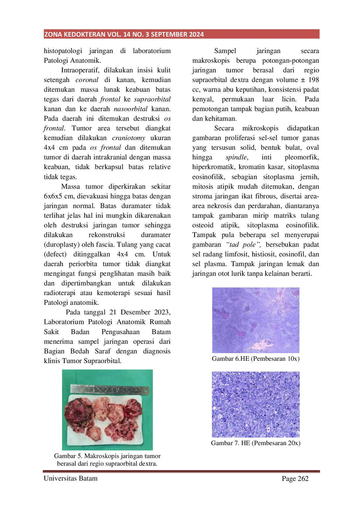 JURIS Primer Sinovial Sarcoma Orbital Dengan Perluasan Intrakranial Pada Anak Gadis Berumur 4 Tahun Laporan Kasus Langka