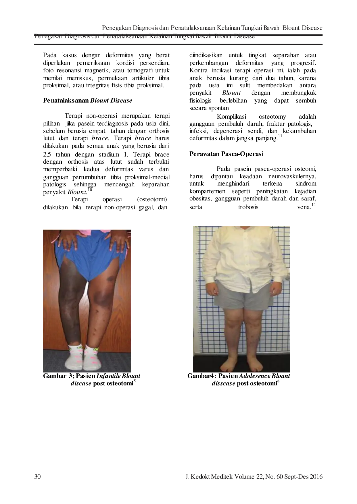 JURIS Penegakan Diagnosis dan Penatalaksanaan Kelainan Tungkai Bawah Blount Disease