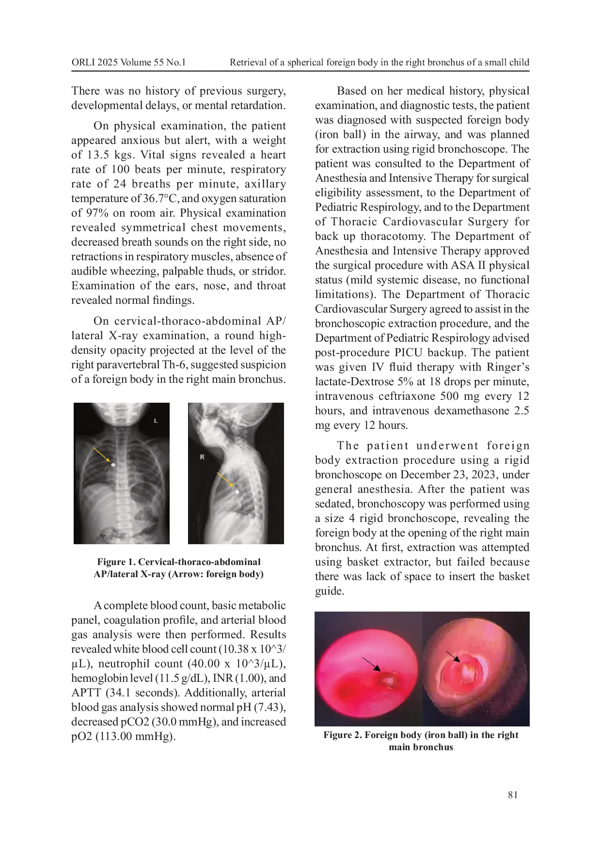 JURIS Retrieval of a Spherical Foreign Body in the Right Bronchus of a Small Child