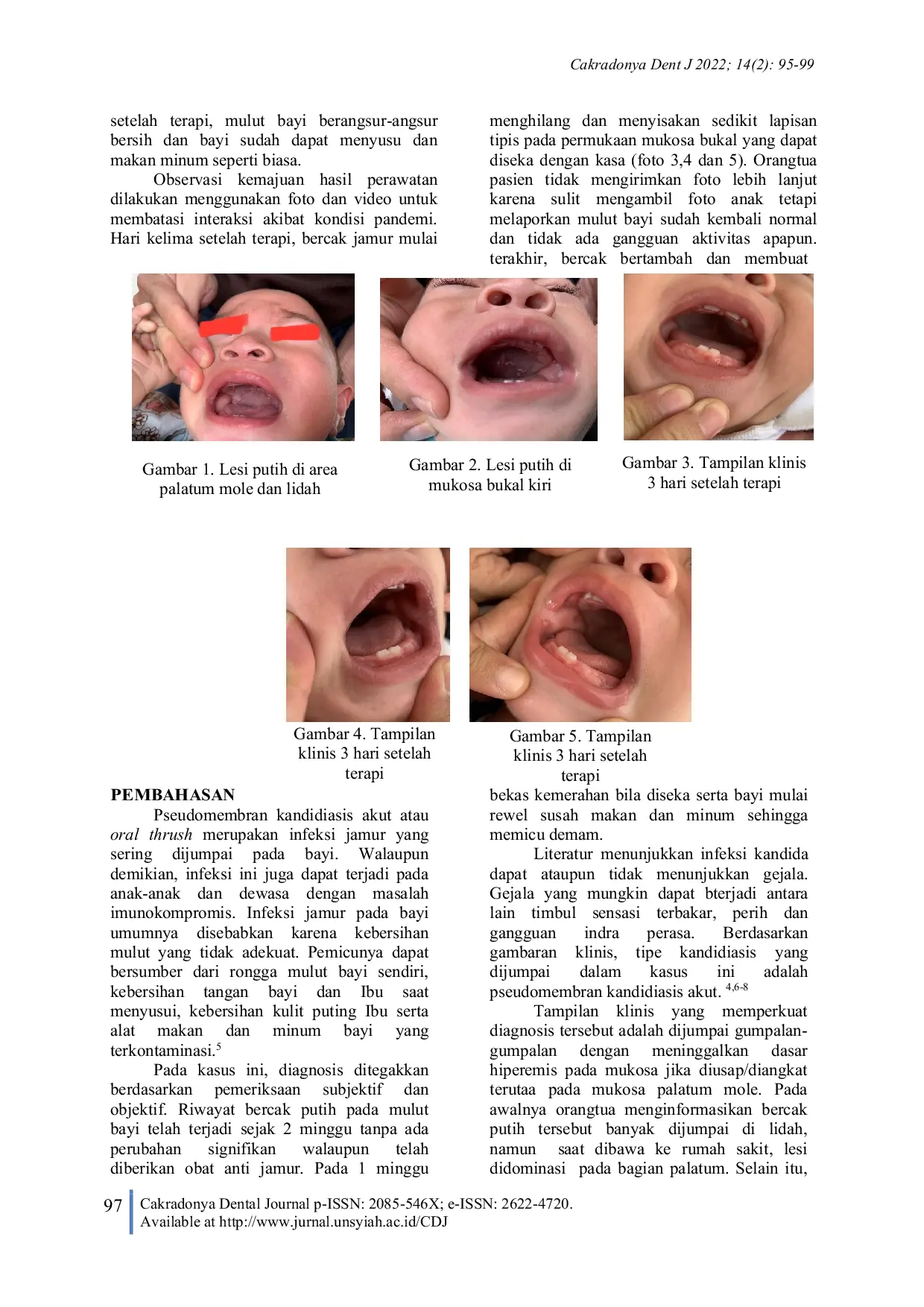 JURIS Oral Thrush Pada Bayi Gambaran Klinis dan Tatalaksana