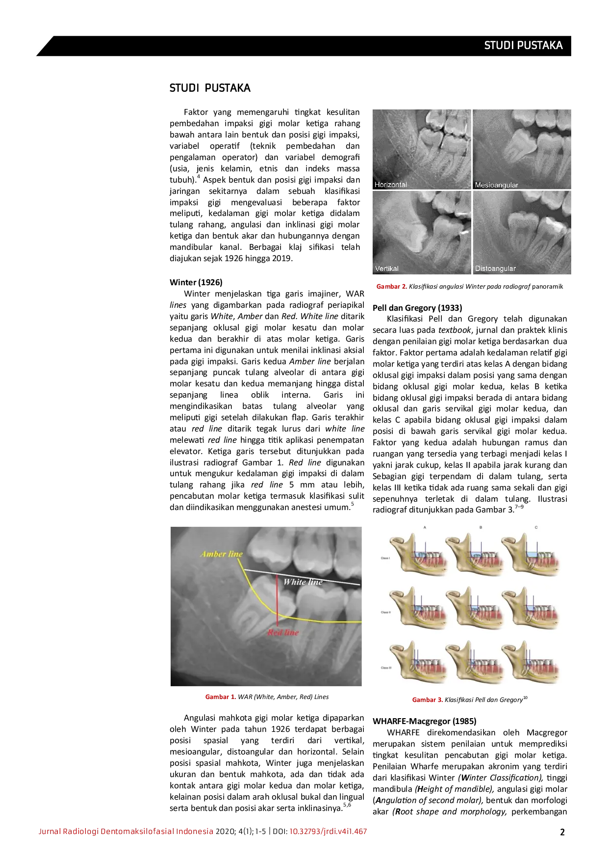 JURIS Klasifikasi impaksi gigi molar ketiga melalui pemeriksaan radiografi sebagai penunjang odontektomi
