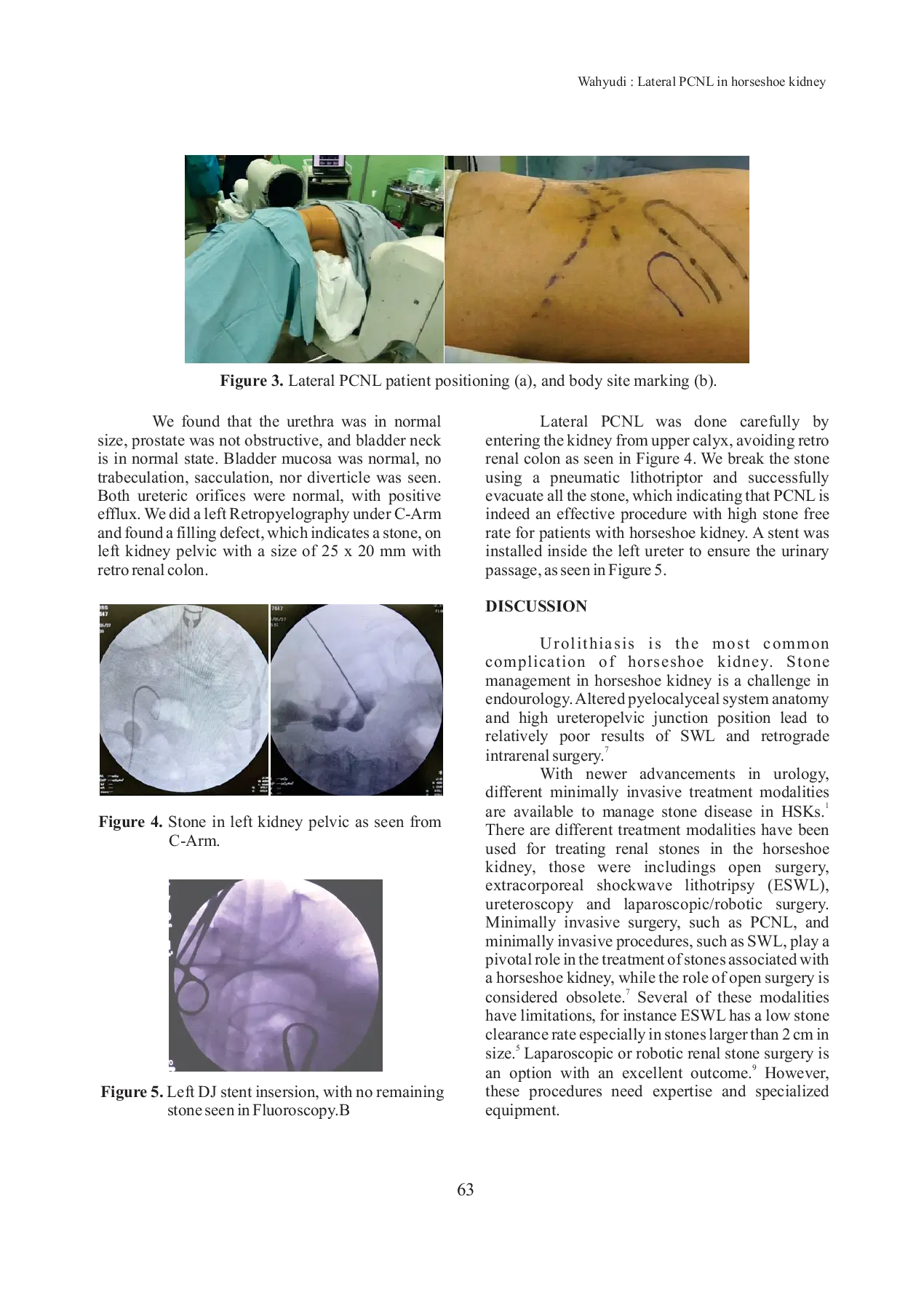 JURIS Lateral Percutaneous Nephrolithotomy in Horseshoe Kidney An Alternative Approach with High Success Rate