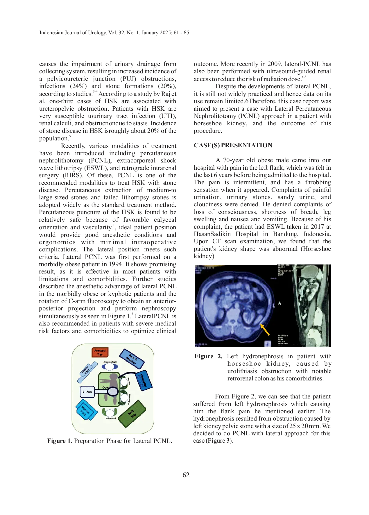 JURIS Lateral Percutaneous Nephrolithotomy in Horseshoe Kidney An Alternative Approach with High Success Rate