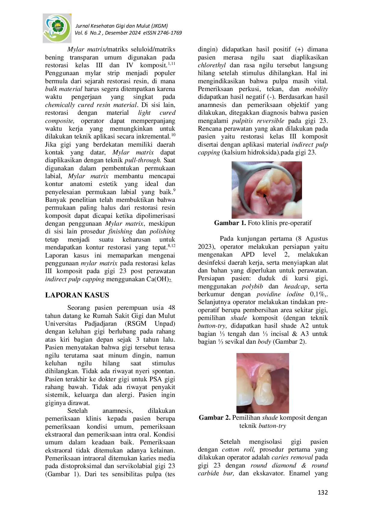 JURIS Penggunaan Mylar Matrix Pada Restorasi Kelas III Komposit Post Perawatan Indirect Pulp Capping Laporan Kasus