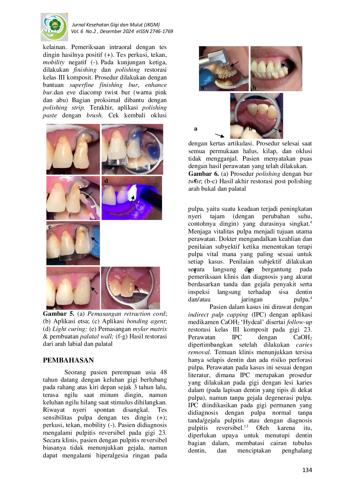 JURIS Penggunaan Mylar Matrix Pada Restorasi Kelas III Komposit Post Perawatan Indirect Pulp Capping Laporan Kasus