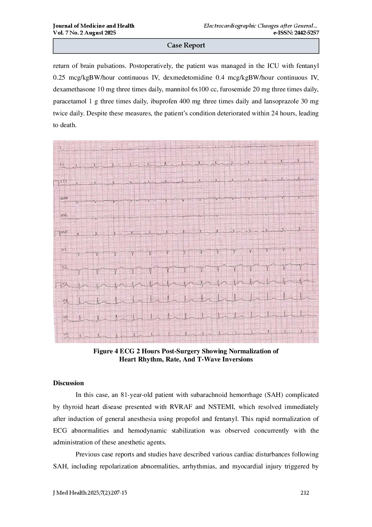 juris Electrocardiographic Changes after General Anaesthesia Induction in a Patient with Subarachnoid Haemorrhage and Thyroid Heart Disease A Case Report