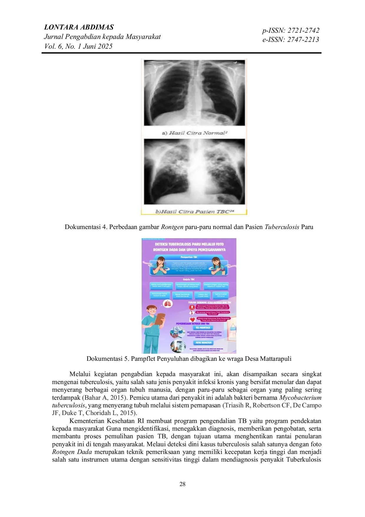 JURIS Penyuluhan Deteksi Tuberculosis Paru Melalui Foto Rontgen Dada dan Upaya Pencegahannya di Desa Mattaropuli