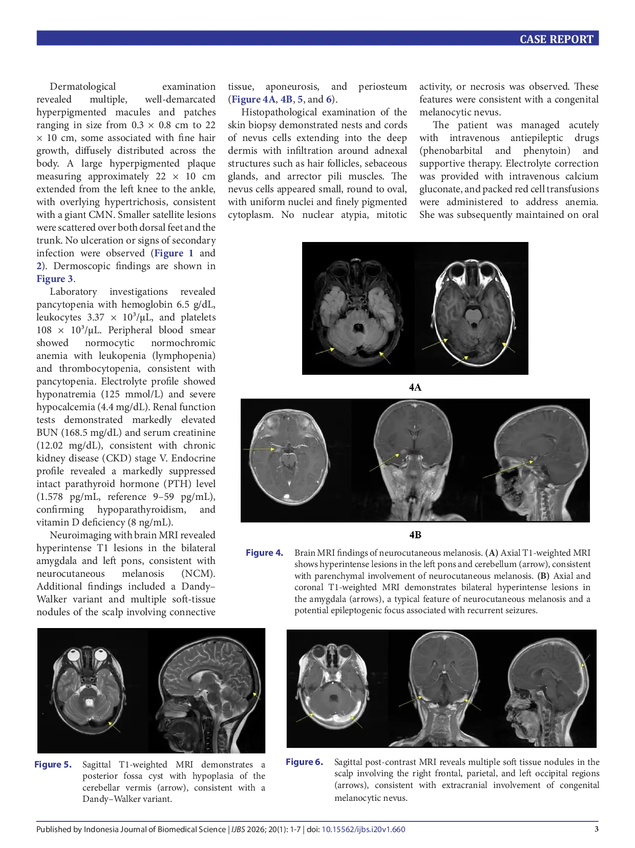 JURIS Neurocutaneous melanosis with giant congenital melanocytic nevus a case report