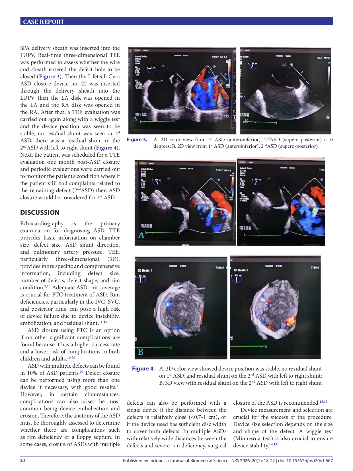 JURIS Multiple atrial septal defects How and when should they be repaired A case report