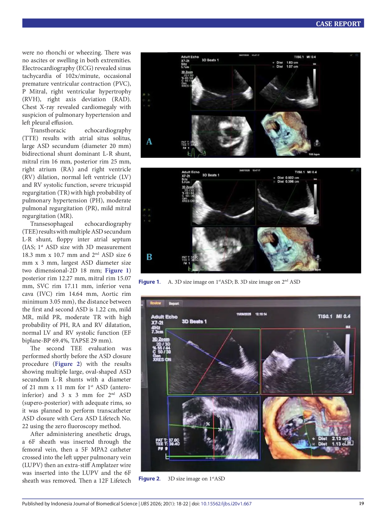 JURIS Multiple atrial septal defects How and when should they be repaired A case report