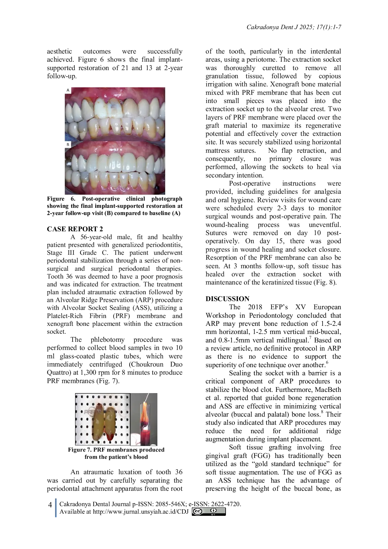 JURIS Alveolar Socket Sealing Using Mucosal Grafts for Alveolar Ridge Preservation