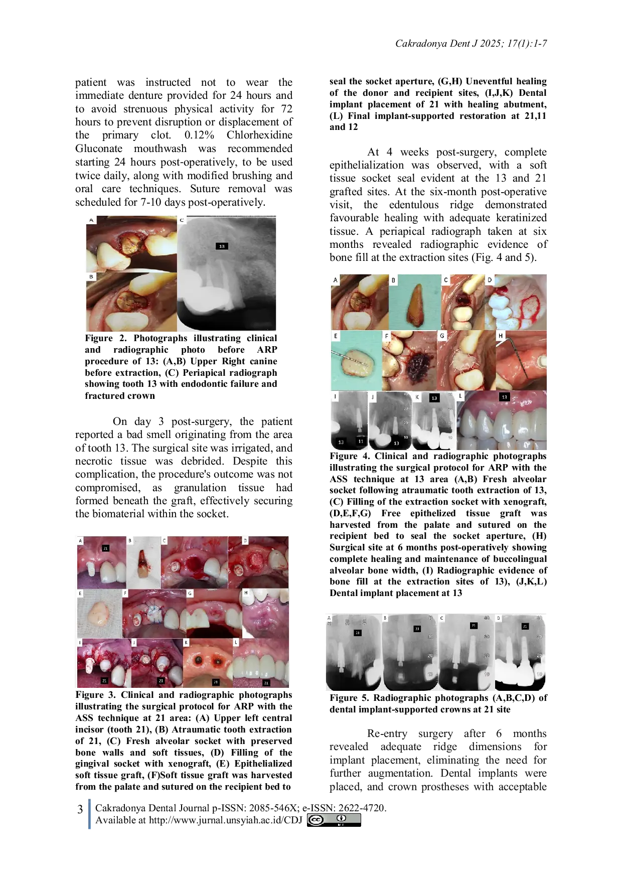 JURIS Alveolar Socket Sealing Using Mucosal Grafts for Alveolar Ridge Preservation