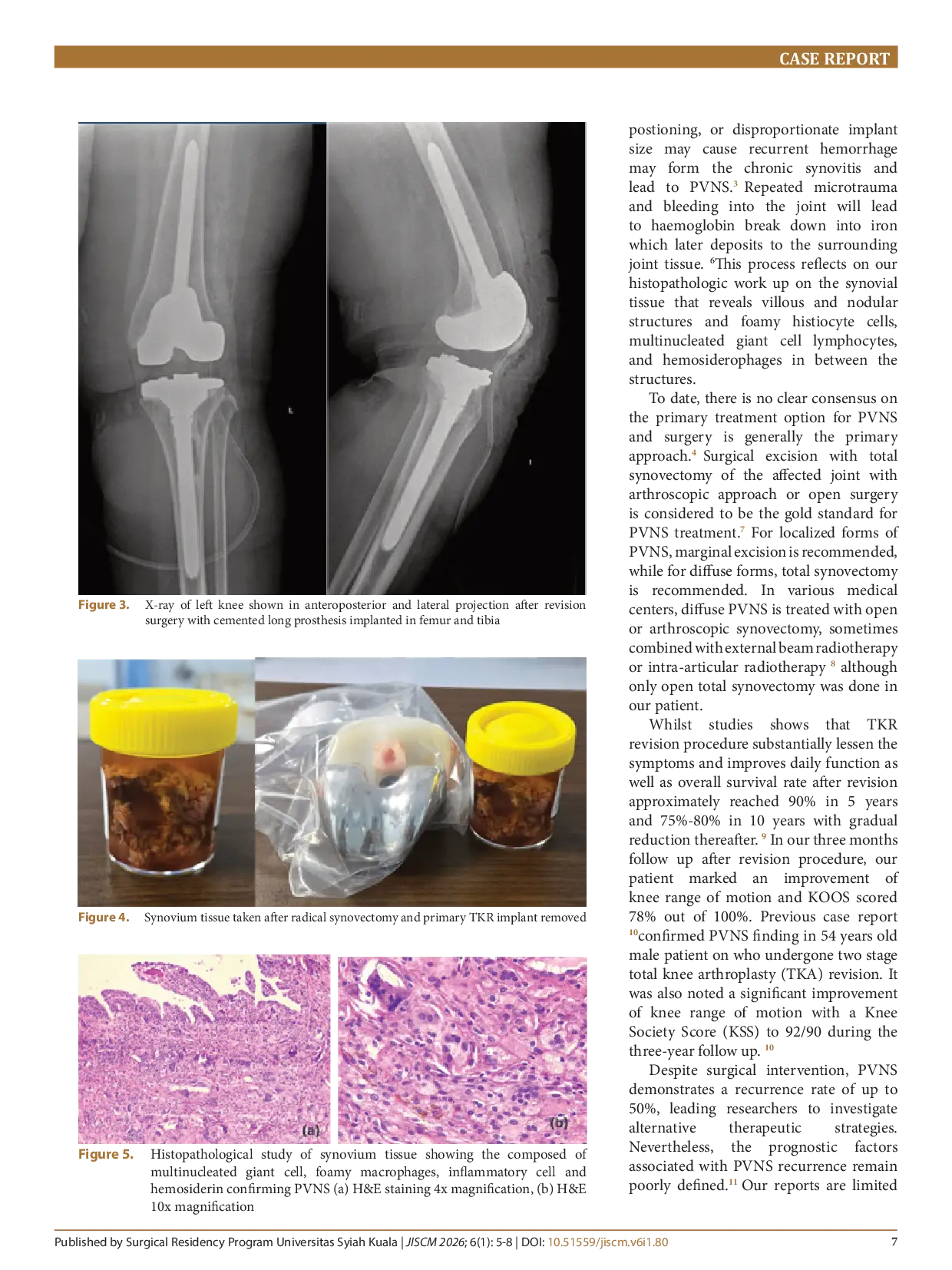 JURIS Implant loosening after total knee replacement with pigmented villonodular synovitis a case report