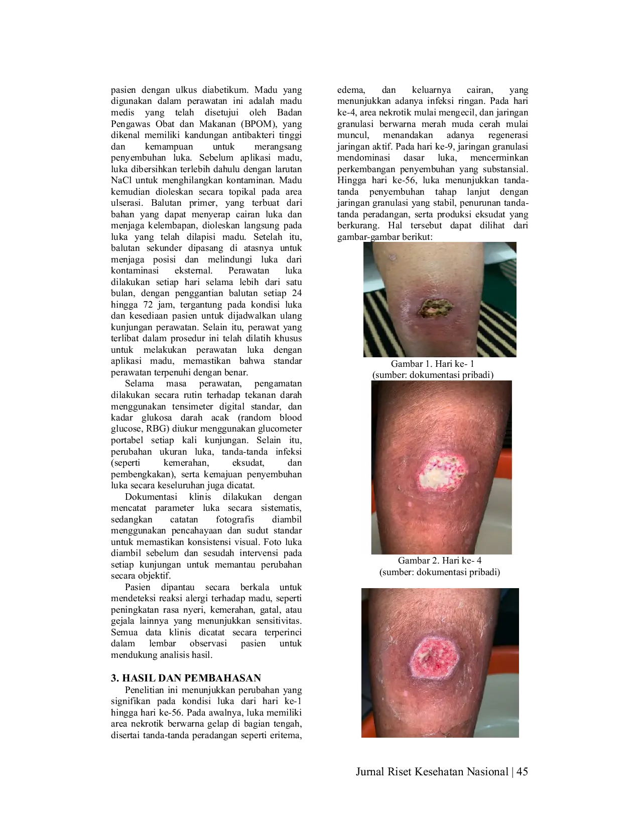 JURIS Peran Madu Sebagai Terapi Utama Penyembuhan Ulkus Diabetik Pada Lansia Studi Kasus