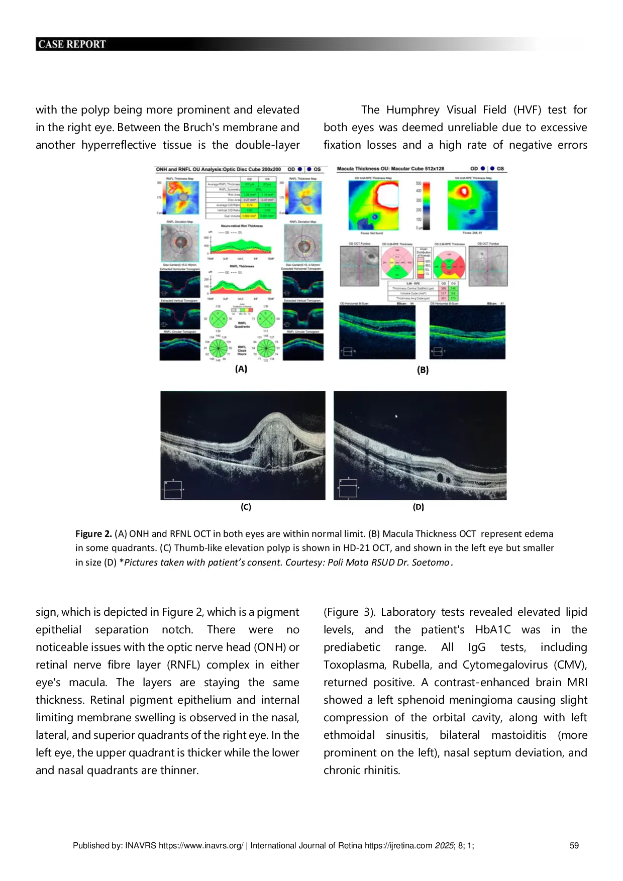 JURIS POLYPOIDAL CHOROIDAL VASCULOPATHY MANIFESTATION IN EXTRA AXIAL CAVERNOUS TUMOR A RARE FINDINGS IN CHRONIC PAPILLEDEMA