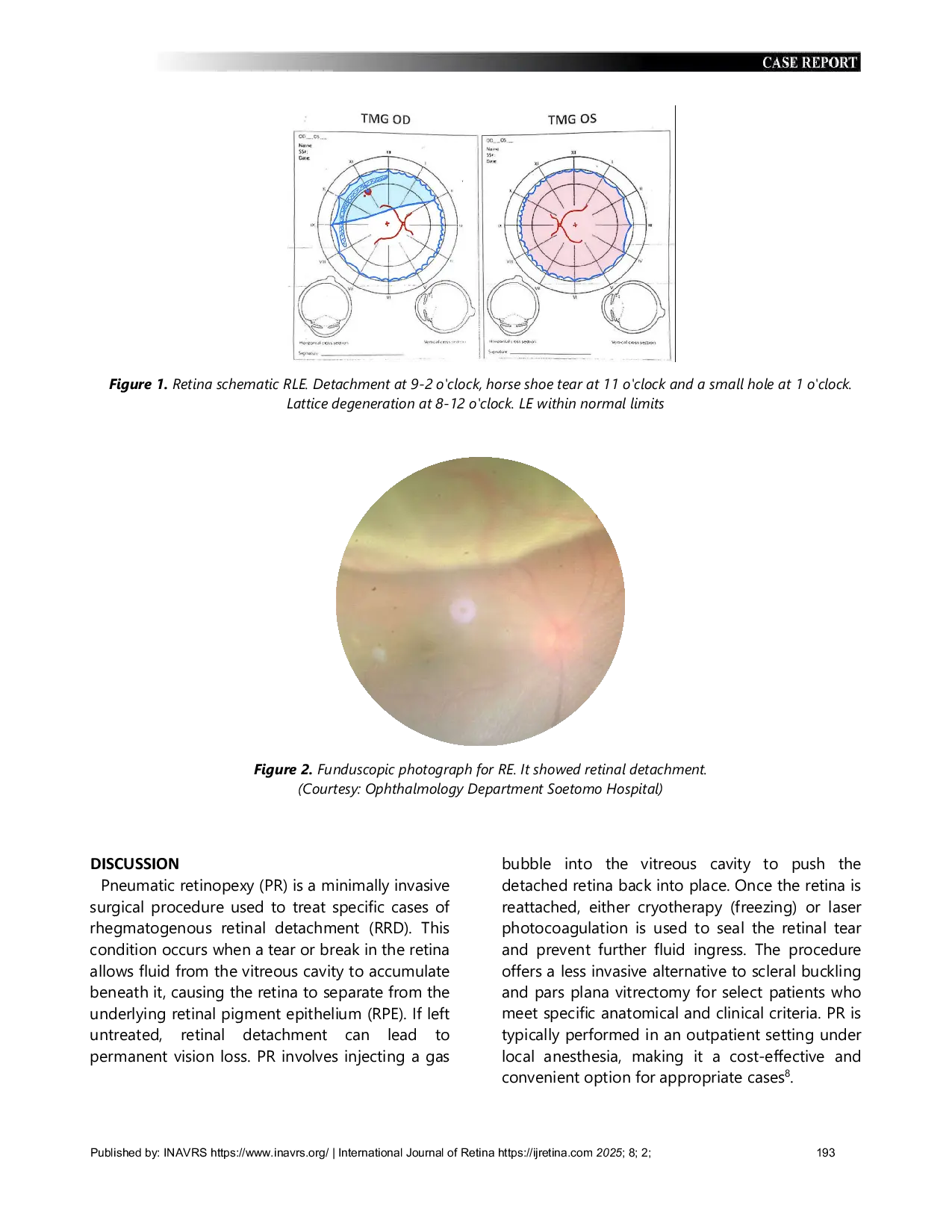 JURIS Minimally Invasive Management of Retinal Detachment Insights from a Pneumatic Retinopexy Case Report