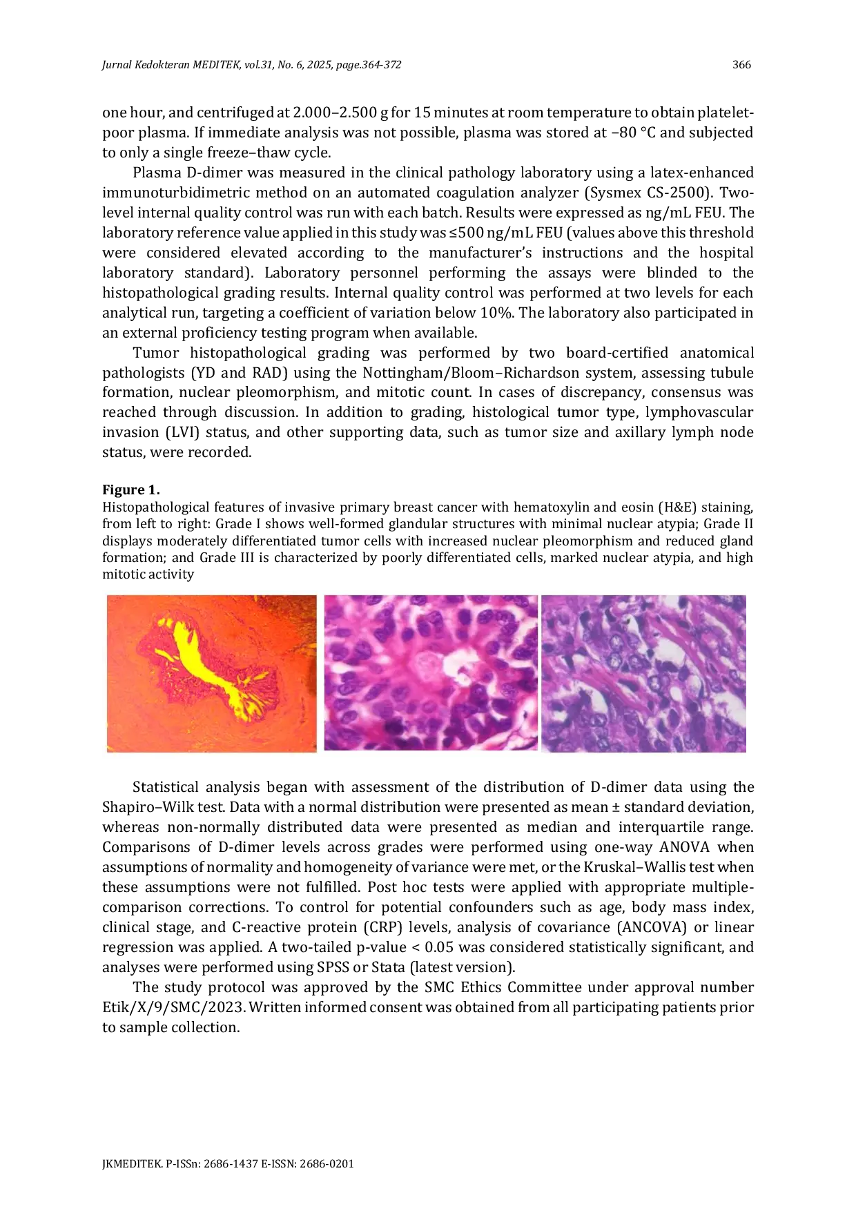 JURIS Analysis of D Dimer Levels Based on Histopathological Grading of Breast Cancer