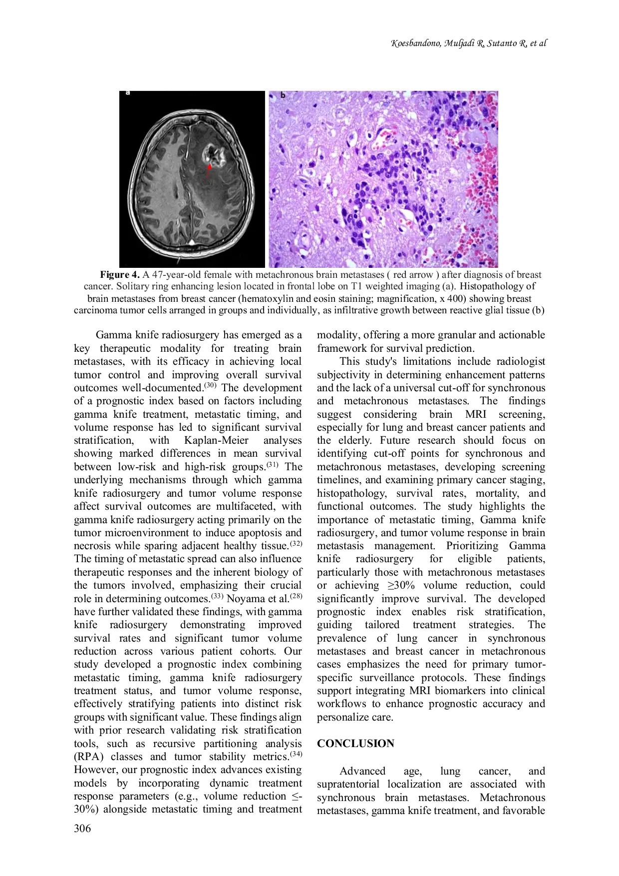 JURIS Prognostic factors of brain metastases affecting survival an Indonesian cohort