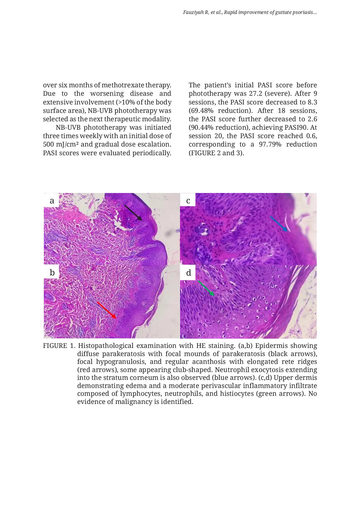 JURIS Rapid improvement of guttate psoriasis following inadequate response to prior systemic therapy using 311 nm narrowband ultraviolet B NB UVB phototherapy