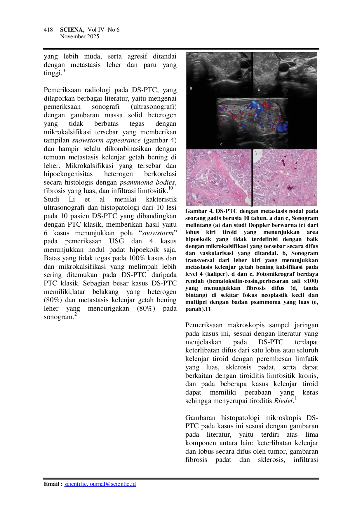 JURIS Diffuse Sclerosing Papillary Thyroid Carcinoma Ds Ptc Kasus Jarang Dengan Perilaku Agresif