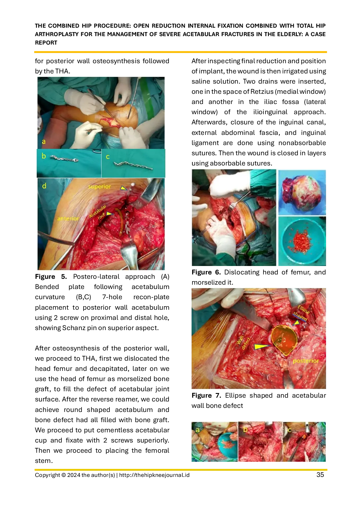 JURIS The Combined Hip Procedure Open Reduction Internal Fixation Combined with Total Hip Arthroplasty for the Management of Severe Acetabular Fractures in the Elderly A Case Report