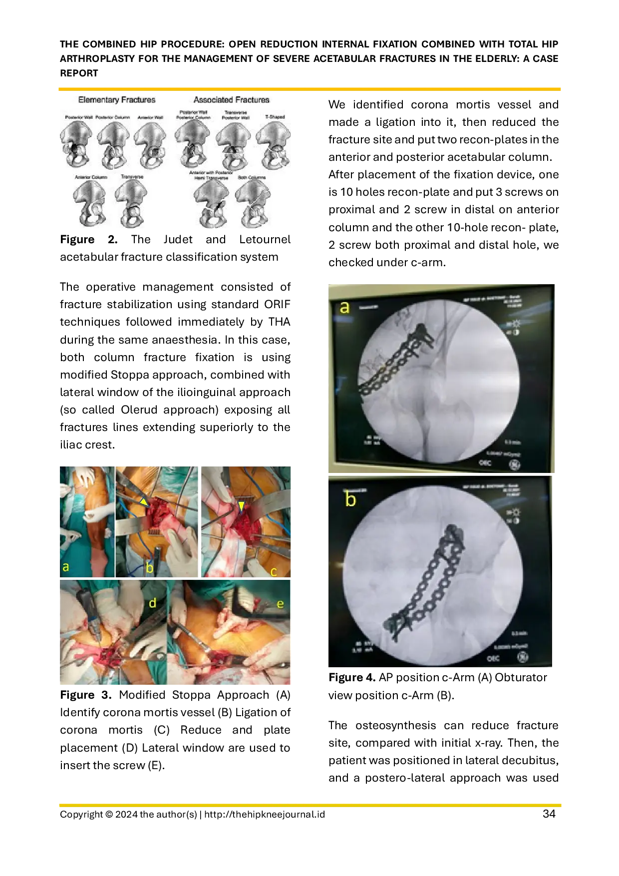 JURIS The Combined Hip Procedure Open Reduction Internal Fixation Combined with Total Hip Arthroplasty for the Management of Severe Acetabular Fractures in the Elderly A Case Report
