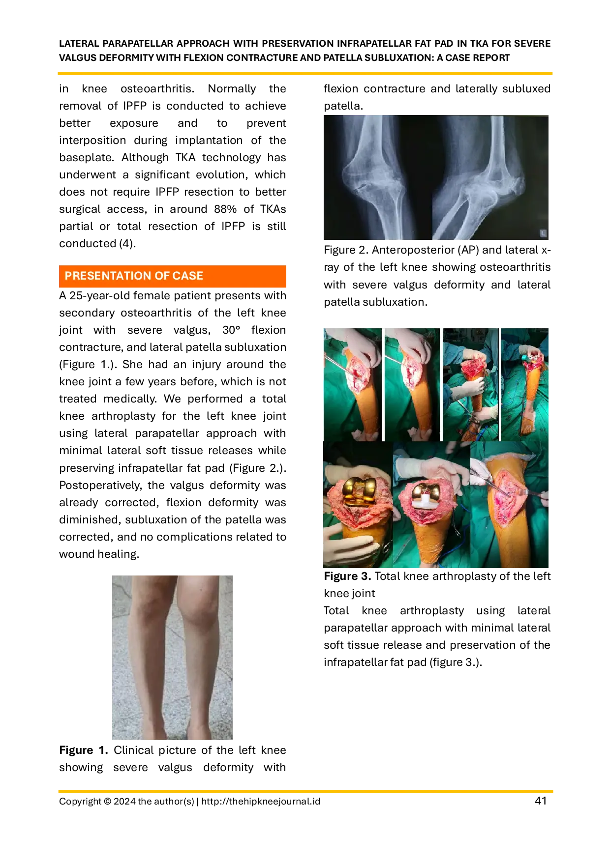JURIS Lateral Parapatellar Approach with Preservation Infrapatellar Fat Pad in TKA for Severe Valgus Deformity with Flexion Contracture and Patella Subluxation A Case Report