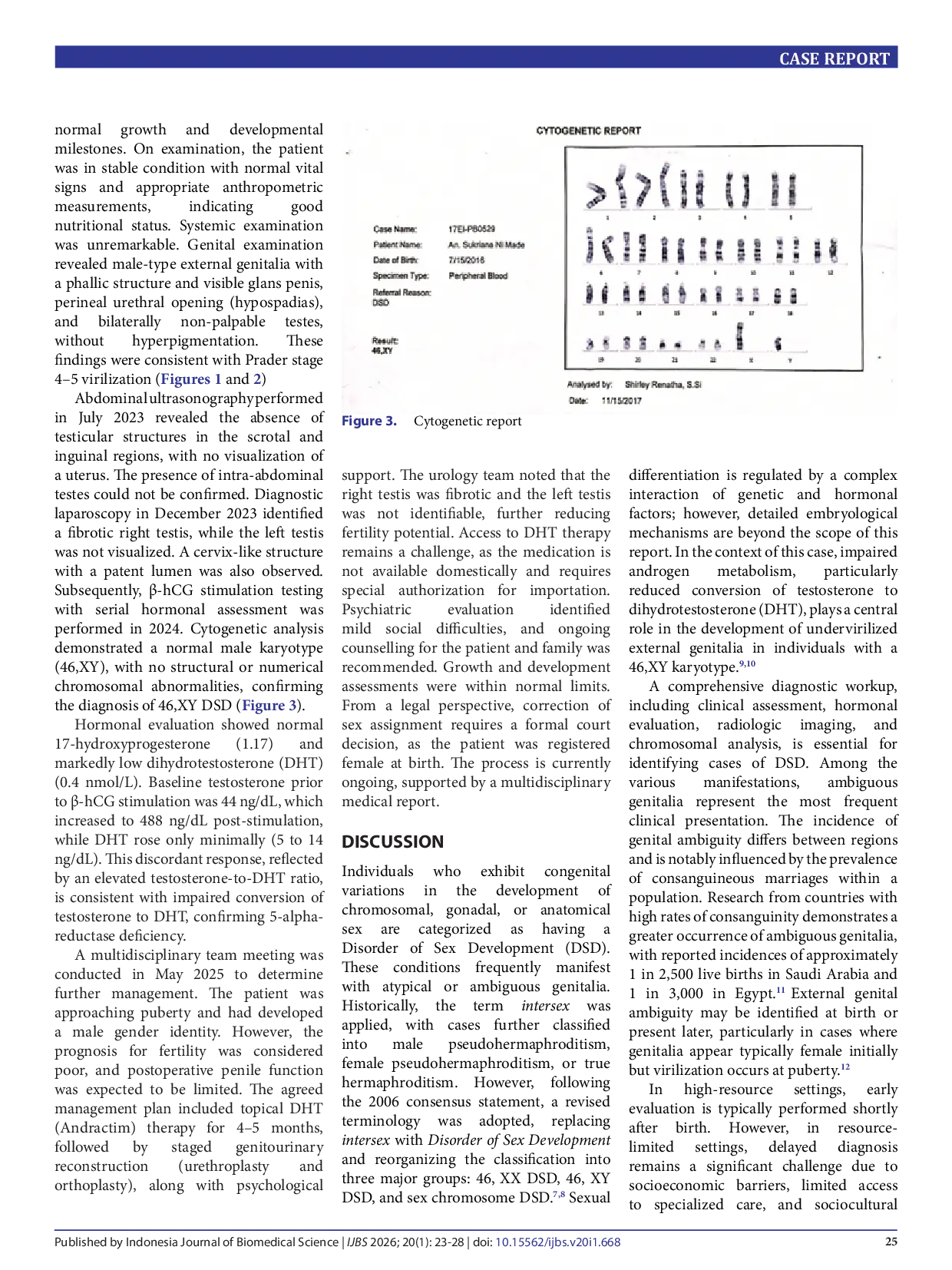 JURIS Diagnostic challenges in 46 XY disorder of sex development due to 5 alpha reductase type 2 deficiency a case report