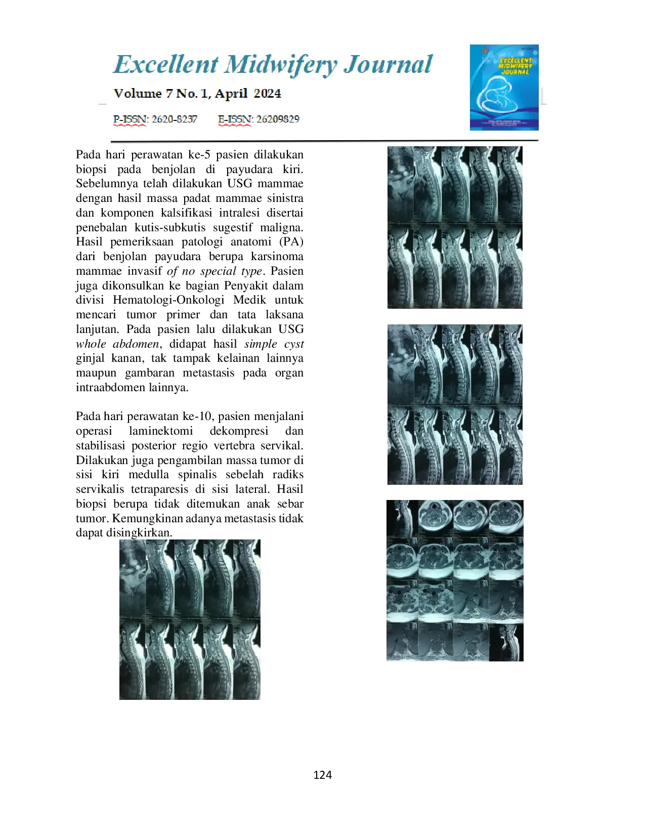 JURIS Pendekatan Klinis dan Diagnostik Kompresi Kanalis Spinalis Ekstradura Metastasis pada Wanita Hamil Trimester III dengan Kanker Payudara Laporan Kasus