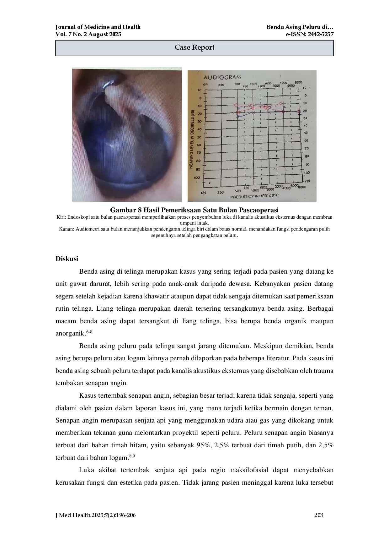 juris Benda Asing Peluru di Kanalis Akustikus Eskternus